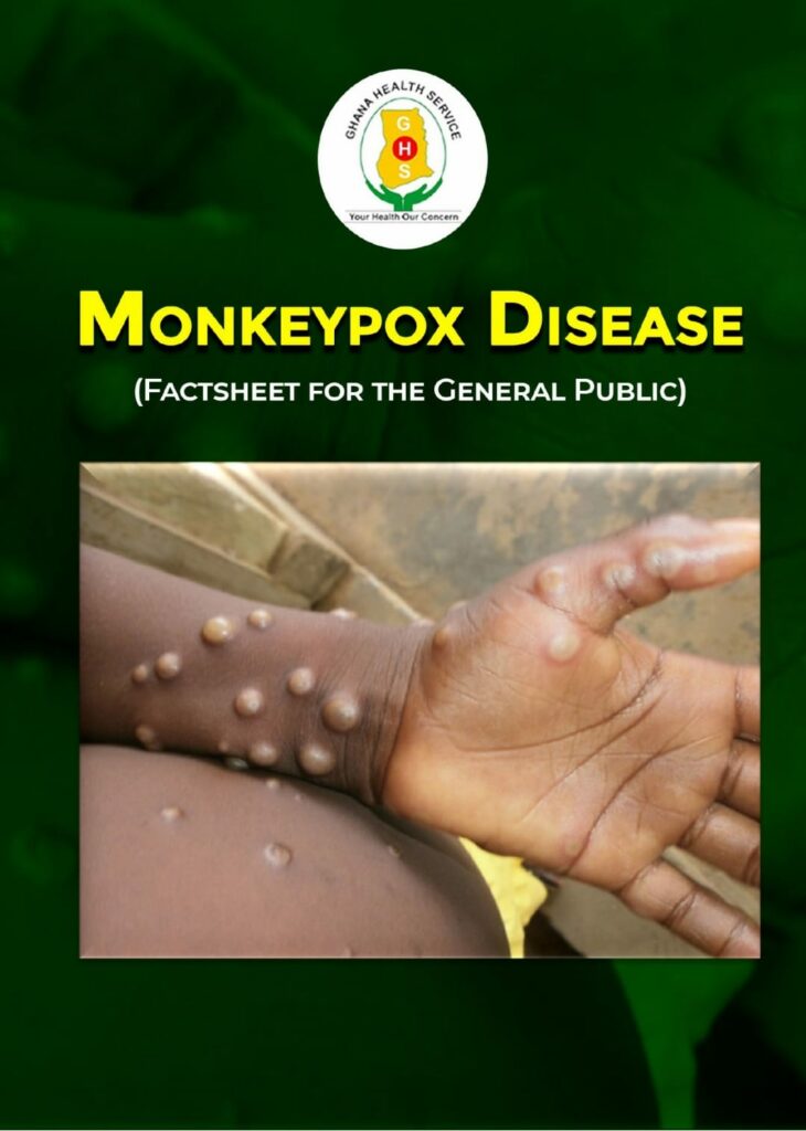 This image has an empty alt attribute; its file name is monkeypox-ghana-1-730x1024.jpg